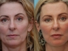 Moderate Volume Loss and tear trough correction facelift at cosmeetic clinic dublin