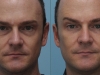 3D, softlift, liquid volume facelift for Men at cosmetic clinic dublin