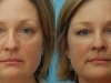 3D softlift Volume Restoration facelift Castleknock Cosmetic Clinic Dublin