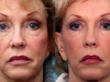 3d-lift, the softlift procedure at Castleknock Cosmetic Clinic Dublin