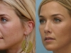 3D softlift volume liquid face lift at Castleknock Cosmetic Clinic Dublin