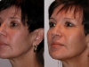 3d softlift volume liquid lift at Castleknock Cosmetic Clinic Dublin