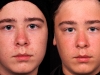 acne-full-face-1 scar active acne cosmetic clinic Dublin