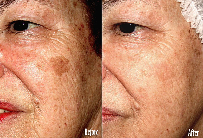 age-spots-2 Age brown spots laseer treatment castleknock laser cosmetic clinic Dublin