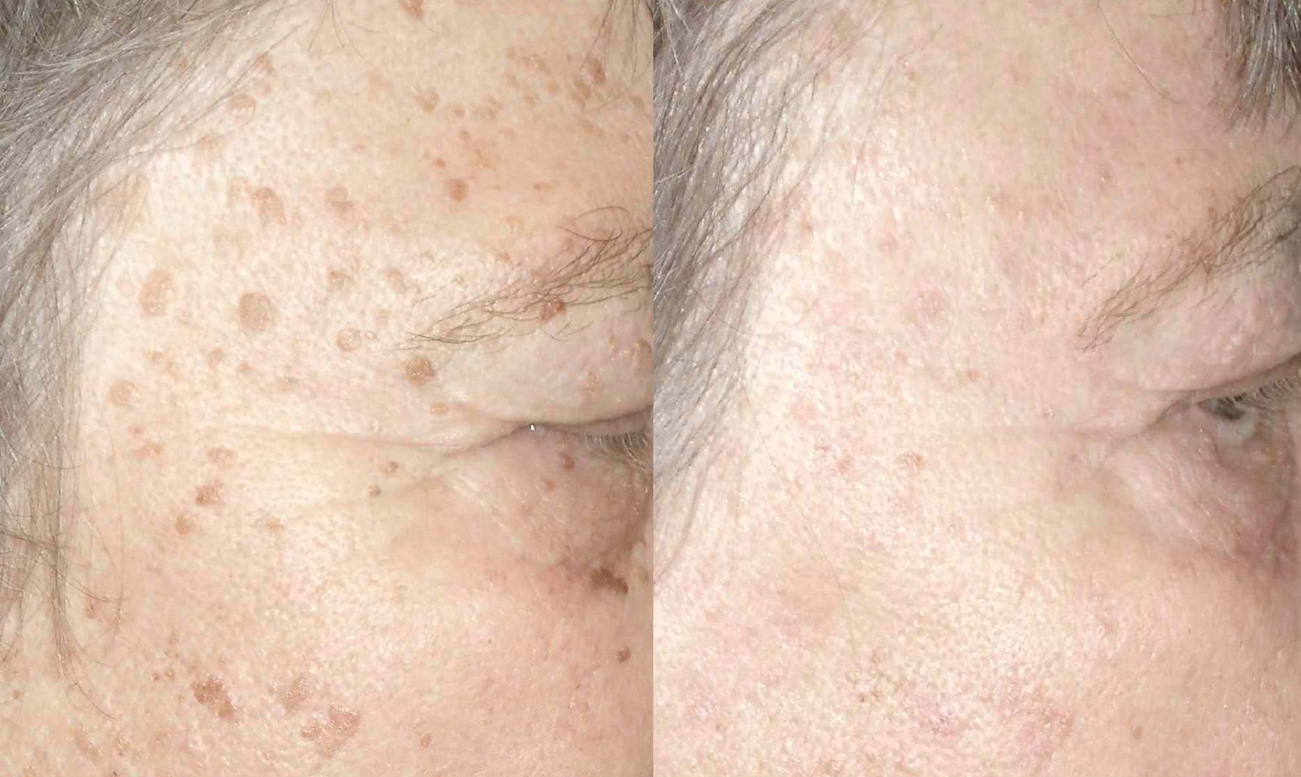 age-spots-4 Age brown spots laseer treatment castleknock laser cosmetic clinic Dublin