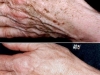 age-spots-1 Age brown spots laseer treatment castleknock laser cosmetic clinic Dublin
