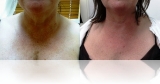 antilax-tightening-3 chest Antilax laser skin tightening RF cosmetic clinic dublin 15