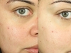 chemical-peel-1 at Castlkenock Cosmetic Clinic Dublin 15