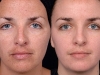 chemical-peel-2 at Castlkenock Cosmetic Clinic Dublin 15