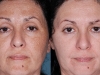 chemical-peel-3 at Castlkenock Cosmetic Clinic Dublin 15