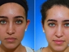 chemical-peel-4 at Castlkenock Cosmetic Clinic Dublin 15