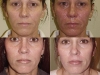 chemical-peel-progression at Castlkenock Cosmetic Clinic Dublin 15