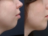 chin-enhancement-1_0