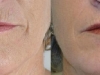 lines and wrinkles scar fractional CO2 Laser castlkenock cosmetic clinic dublin 15