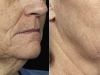 skin tightening fractional CO2 Laser castlkenock cosmetic clinic dublin 15