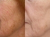saggy skin fractional CO2 Laser castlkenock cosmetic clinic dublin 15