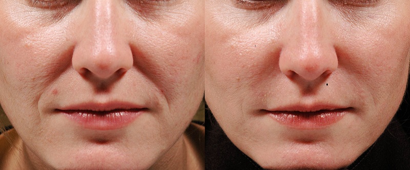 Nose to lip lines folds dermal fillers cosmetic clinic dublin