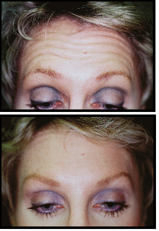 eyebrow lift with botox clinic dublin 15