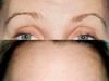 eyebrow lift with botox clinic dublin 15