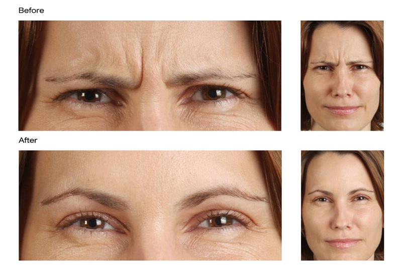compare Frown Lines botox castlkenock cosmetic clinic dublin