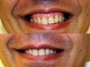 gummy smile botox cosmetic clinic dublin 15