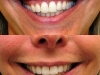gummy smile botox cosmetic clinic dublin