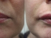 Lip Augmentation volume enhancement dermal fillers