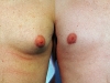 man-boobs-1 Vaser lipo cosmetic surgery clinic dublin 15