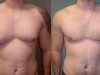 man-boobs pecs Vaser lipo cosmetic surgery clinic dublin 15