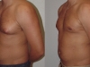man-boobs-3 Vaser lipo cosmetic surgery clinic dublin 15