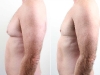 man-boobs-4 Vaser lipo cosmetic surgery clinic dublin 15