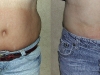 vaser-for-men-2 Man Vaser lipo liposuction cosmetic surgery clinic Dublin