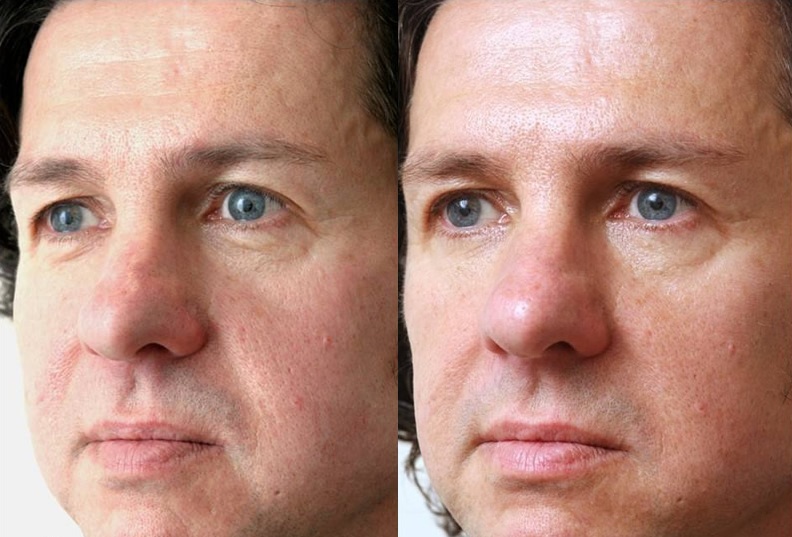 Wrinkle Treatment for Men with botox cosmetic clinic dublin
