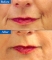 Marionette Lines dermal filler at Castleknock cosmetic clinic Dublin 15