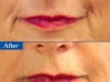 Marionette Lines dermal filler at Castleknock cosmetic clinic Dublin 15