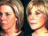 mini-lift-1 mini_facelift thread lift face lift cosmetic clinic dublin