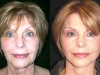 mini-lift-2 mini_facelift thread lift face lift cosmetic clinic dublin