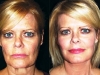 mini-lift-4 mini_facelift thread lift face lift cosmetic clinic dublin