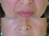 naolabial-lines-2 deep  at Castleknock cosmetic clinic Dublin 15