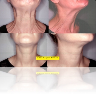 neck-bands-botox