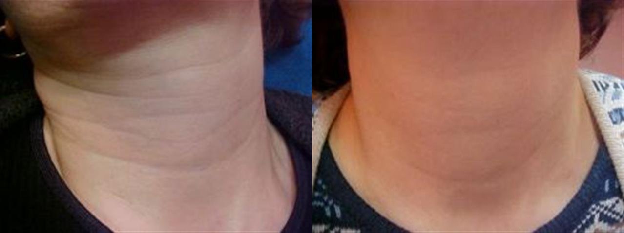 neck-lines-botox