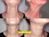 neck-bands-botox