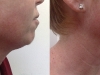 skin-tightening-neck
