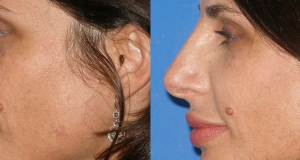 Non Surgical Nose Correction nose job without no surgery dermal fillers cosmetic clinic Dublin