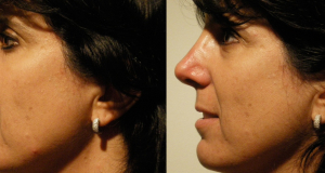 Non Surgical Nose Correction nose job without no surgery dermal fillers cosmetic clinic Dublin