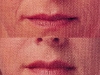 nl-lines dermal fillers at castleknock cosmetic clinic dublin 15
