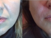 parenthesis-lines deep lines dermal fillers at castleknock cosmetic clinic dublin 15