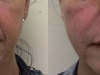 parenthesis-lines dermal fillers at castleknock cosmetic clinic dublin 15