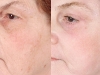 photo-rejuvination ruddy skin  laser at Castleknock cosmetic clinic dublin 15