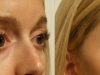 undereye-bags gaunt fix cosmetic clinic dublin